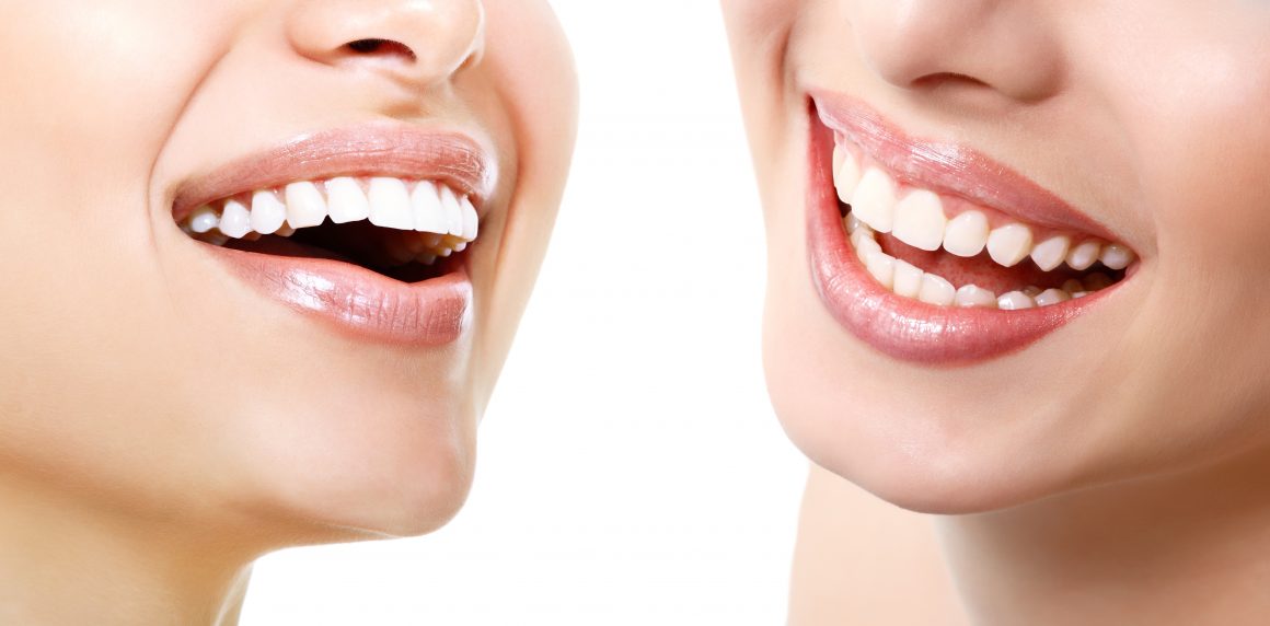 Estetinis protezavimas – dantų ir implantų